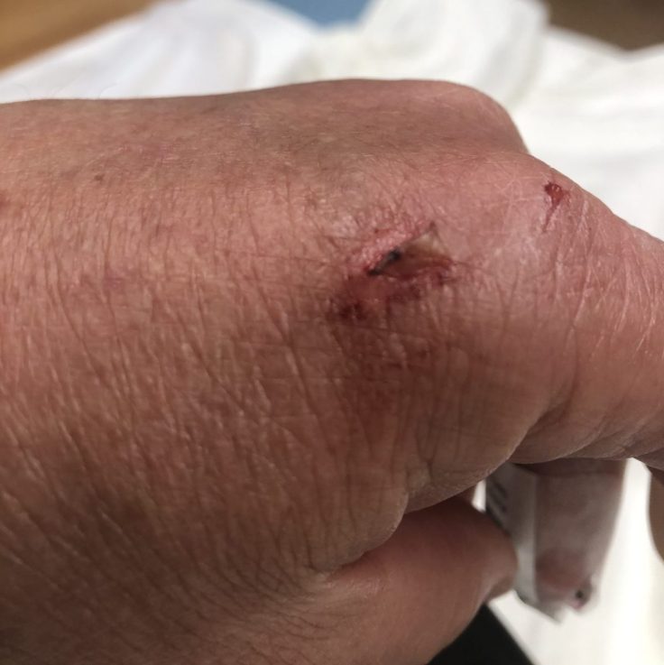My injury